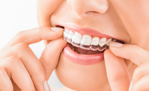 Invisalign teeth straightening